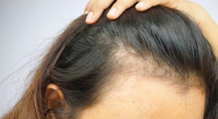 alopecia femenina